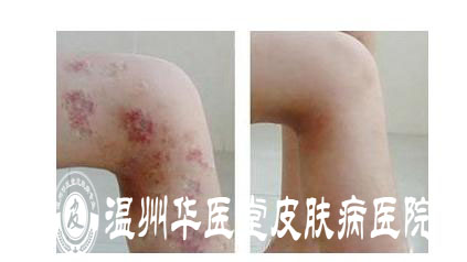合肥肤康治疗湿疹