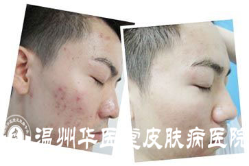 合肥肤康治疗痤疮