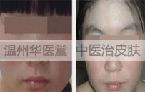 皮炎可以分为哪几种类型