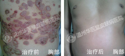 合肥肤康皮肤病医院牛皮癣图片
