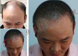 导致脱发的原因有哪些