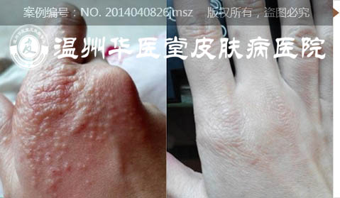 湿疹的发病因素有哪些
