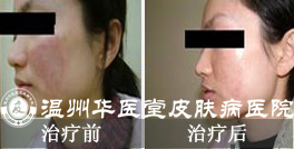 过敏性皮炎的危害