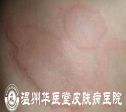 荨麻疹的症状