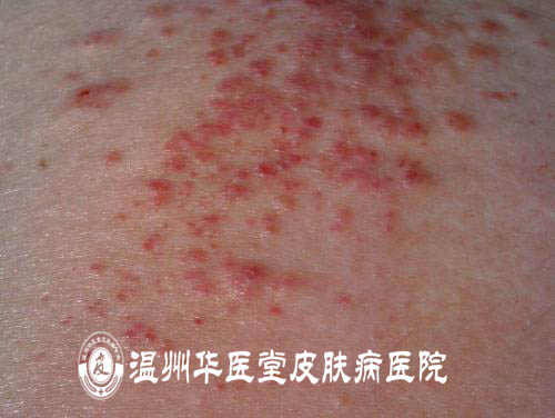 湿疹是什么原因引起的