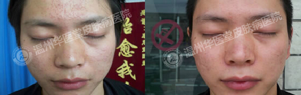 青春痘