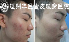 青春痘